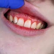 Gencives qui saignent : quand faut-il consulter un dentiste à La Réunion ?